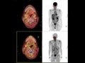 PET CT image of the Neck showing CA nasopharynx or carcinoma of nasopharynx from PET CT scannner Royalty Free Stock Photo