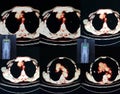 Pet/ct level of lungs Royalty Free Stock Photo