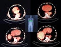 Pet/ct level of mediastinum Royalty Free Stock Photo