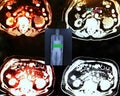 pet/ct on level of renal tumor Royalty Free Stock Photo