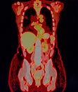 pet/ct of lung cancer