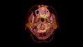 PET CT Scan fusion image It provides detailed images by merging