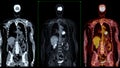 PET CT Scan fusion image It provides detailed images by merging