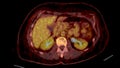 PET CT Scan fusion image It provides detailed images by merging