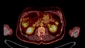 PET CT Scan fusion image It provides detailed images by merging