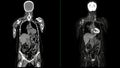 PET CT Scan fusion image It provides detailed images by merging