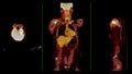 PET CT Scan fusion image It provides detailed images by merging