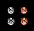 PET CT Scan image of the brain in axial plane . Royalty Free Stock Photo