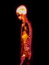 A PET-CT scan image is a diagnostic visualization combining Positron Emission Tomography (PET). Royalty Free Stock Photo