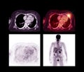 PET CT Scan image of whole body comparison Axial ,Sagittal and  plane Royalty Free Stock Photo