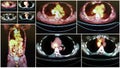 Pet ct tumor mediastinum and lung collage Royalty Free Stock Photo