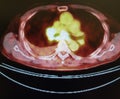 Pet ct tumor mediastinum penetrating lung frame