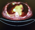 Pet ct tumor mediastinum penetrating lung frame