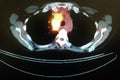 Pet ct tumor mediastinum penetrating lung frame Royalty Free Stock Photo