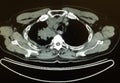 Pet ct tumor mediastinum penetrating lung frame