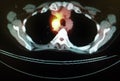 Pet ct tumor mediastinum penetrating lung frame Royalty Free Stock Photo