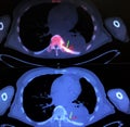 Pet ct vertebral body metastasis nuclear medicine