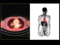 PET Scan image of thorax or chest Comparison Axial , Coronal for detect lung cancer recurrence