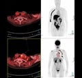 PET Scan image of thorax or chest  Comparison Axial , Coronal  for detect lung cancer recurrence after surgery. medical technology Royalty Free Stock Photo