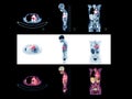 PET Scan image of whole body Comparison Axial , Coronal and Sagittal plane f Royalty Free Stock Photo