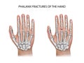 Phalanx Fractures of the Hand.