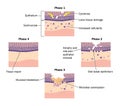 Phases of epithelial repair Royalty Free Stock Photo