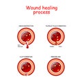 Phases of the wound healing process. poster with capillary, red blood cells, fibrin protein and platelets that healing wound