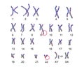 Philadelphia chromosome karyotype