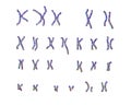 Philadelphia chromosome karyotype