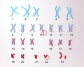 Philadelphia chromosome karyotype