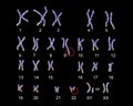 Philadelphia chromosome karyotype Royalty Free Stock Photo