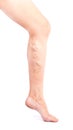 Phlebeurysm disease on legs on white background. Varicose veins