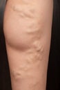 Phlebeurysm, varicose veins of the lower extremities close-up, peripheral vascular disease Royalty Free Stock Photo