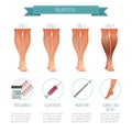 Phlebology infographic, treating varicose veins. Vector illustration of stage of vein diseases. Medical compression Royalty Free Stock Photo