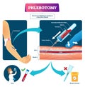 Phlebotomy vector illustration. Labeled veins blood samples process scheme. Royalty Free Stock Photo