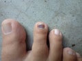 Photo of blood clotted nail