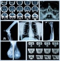 Photo collage: Radiography of Human Bones Royalty Free Stock Photo