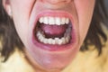 Photo of crooked woman teeth