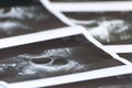 Photo diagnostic ultrasonography of foliculometry in the protocol of the eco program in the process of hormonal stimulation. Ivf Royalty Free Stock Photo