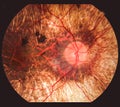 Photo of human eye retina
