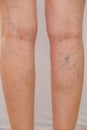 Photo of the legs of an old woman in white panties with cellulite and varicose veins on a light isolated background. Royalty Free Stock Photo