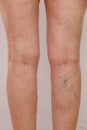 Photo of the legs of an old woman in white panties with cellulite and varicose veins on a light isolated background. Royalty Free Stock Photo