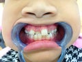A little girl with heavy cross bite condition which is a type of oral misalignment is showing her teeth to the dentist. Pranburi, Royalty Free Stock Photo