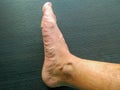 photo of a man's flat foot. Problems and possible remedies