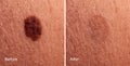 Photo before and after removal of large mole on woman`s skin. Mole removal concept Royalty Free Stock Photo