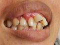 Photo of woman mouth with the upper and lower opposing teeth do not align or Malocclusion.