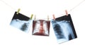Photo of x-ray human shoulder Royalty Free Stock Photo