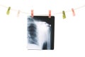 Photo of x-ray human shoulder Royalty Free Stock Photo