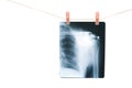 Photo of x-ray human shoulder Royalty Free Stock Photo