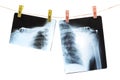 Photo of x-ray human shoulder Royalty Free Stock Photo